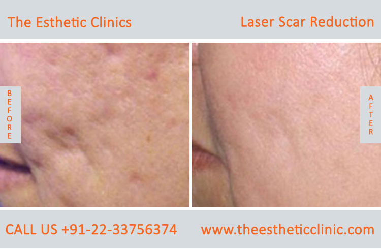 Laser scar reduction removal Treatment before after photos in mumbai india (5)